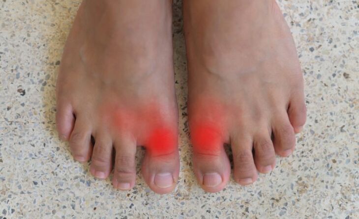Pain in the big toe with gout